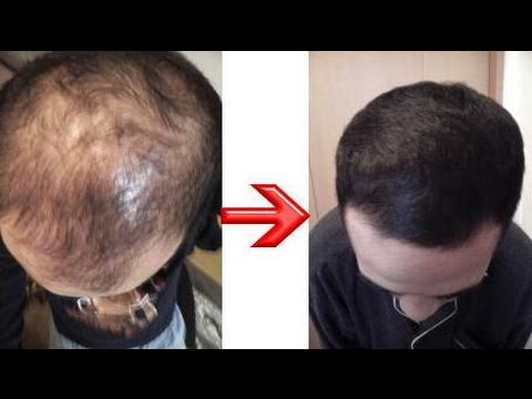 how to regrow hair on head scar